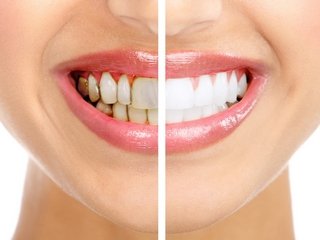 Насколько безопасно отбеливание зубов