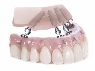 Технология ALL-ON-4 - имплантация зубов по новой методике