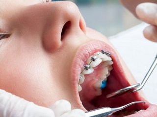 Лечение зубов: виды пломб и качественная работа специалистов